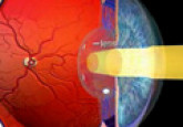 Diabetis: Causes and Prevention of Diabetic Retinopathy